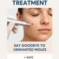 Mole Removal Treatment Derma One Clinic Vizag