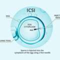 ICSI Treatment Cost In Delhi - Dr Rajat Gupta