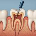 Root Canal Treatment In Pune | Painless RCT By Expert Dentists