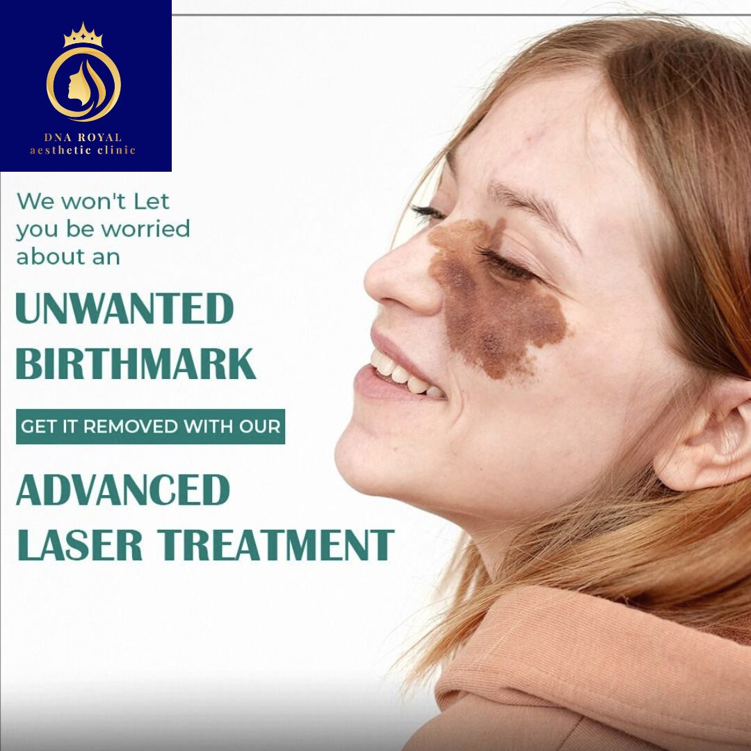 Thane, Fashion & Design, Advanced Laser Birthmark Removal In Thane | DNA Royal Skin Clinic.