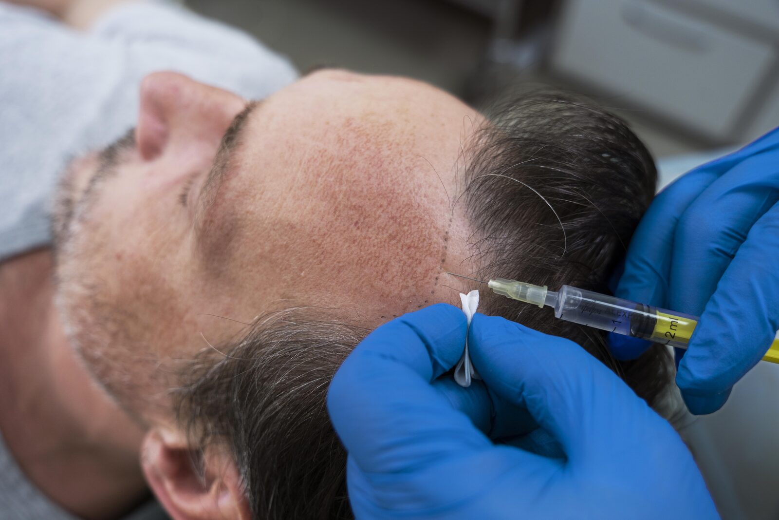 Mumbai, Health, FUE Vs. FUT: Comparing Hair Transplant Techniques | Hair Aesthetica