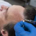 FUE Vs. FUT: Comparing Hair Transplant Techniques | Hair Aesthetica