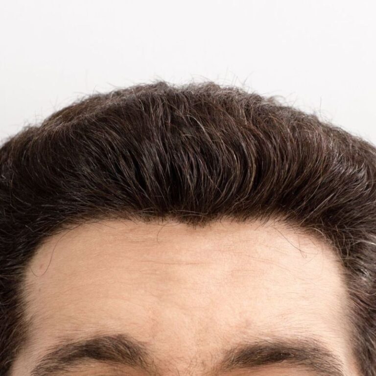 London, Health, SMP For Hairline - Professional Scalp Micropigmentation By Skulltec