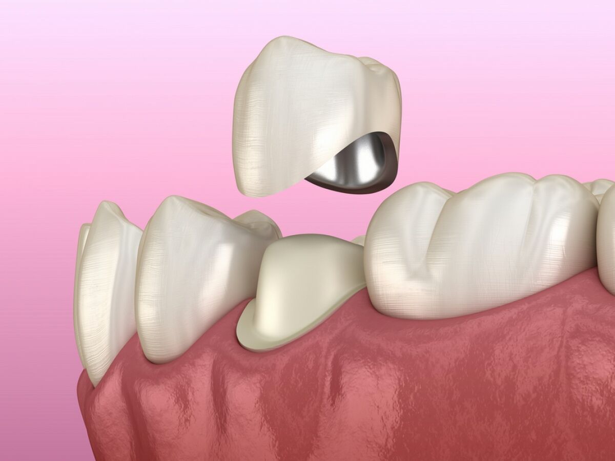 Surrey, Dental, Crown Surrey