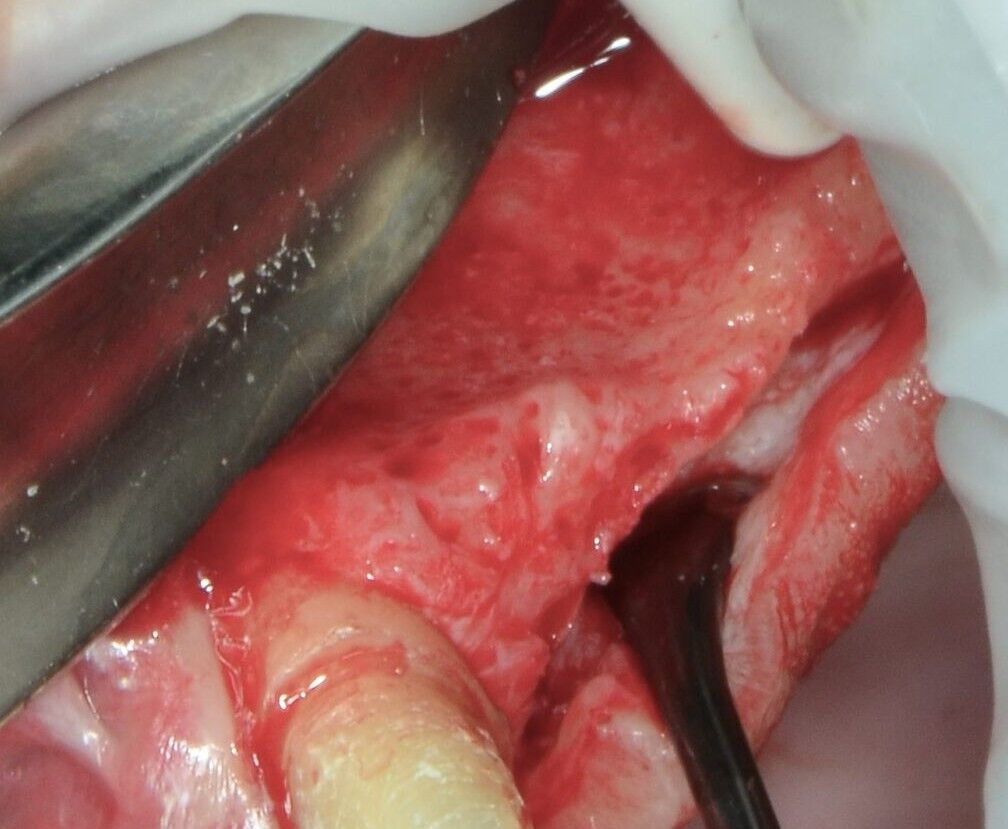 New York, Health, Advanced Tooth Removal With Bone Preservation Treatment