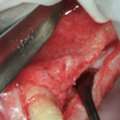 Advanced Tooth Removal With Bone Preservation Treatment