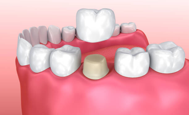 Pune, Dental, Best Dental Crowns In Pune | Expert Crown Treatment