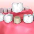 Best Dental Crowns In Pune | Expert Crown Treatment