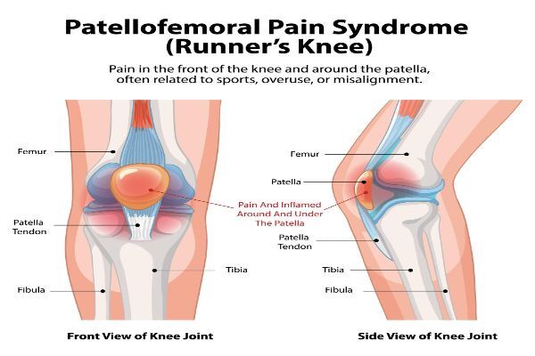 New York, Medical, Patellofemoral Pain Syndrome Treatment &ndash; NYC Knee Specialist