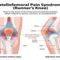 Patellofemoral Pain Syndrome Treatment &ndash; NYC Knee Specialist