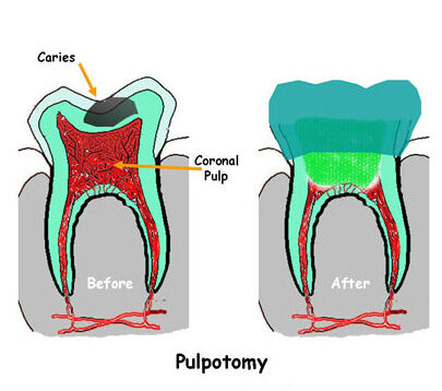 Ahmedabad, Dental, Expert Pulpectomy Treatment In Ahmedabad The Dental Wellness Centre