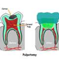 Expert Pulpectomy Treatment In Ahmedabad The Dental Wellness Centre
