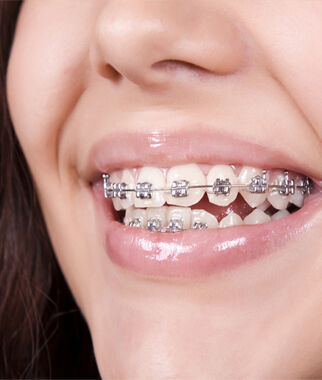 Noida, Dental, Braces Specialist In Noida
