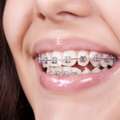 Braces Specialist In Noida
