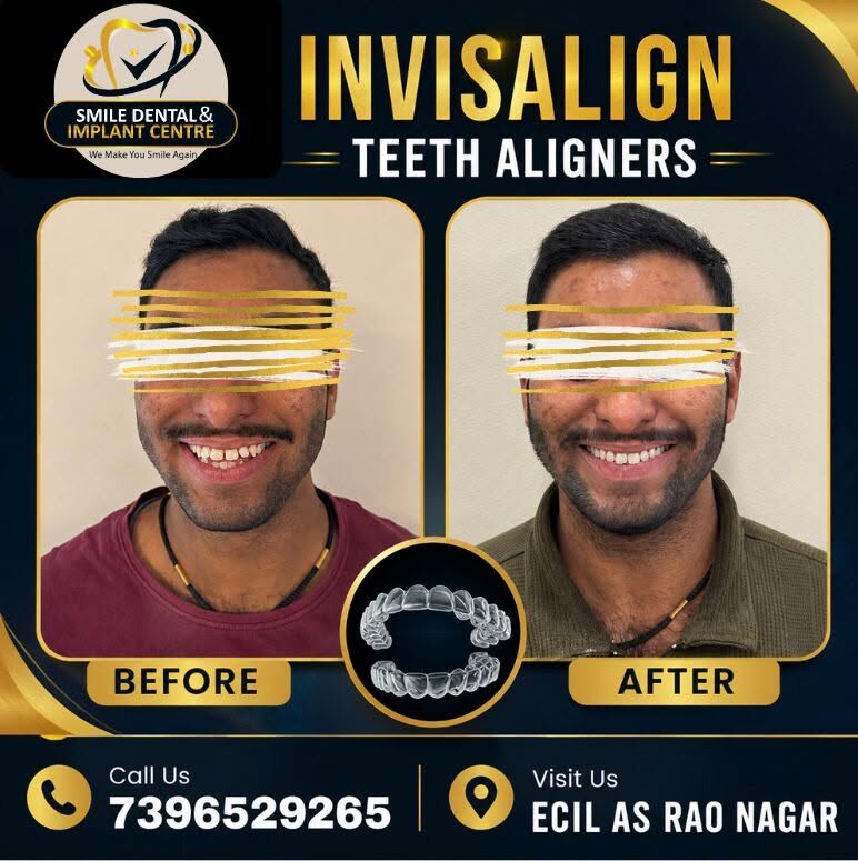 Hyderabad, Dental, Get A Straight Smile With Invisalign Aligners In AS Rao Nagar!