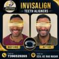 Get A Straight Smile With Invisalign Aligners In AS Rao Nagar!