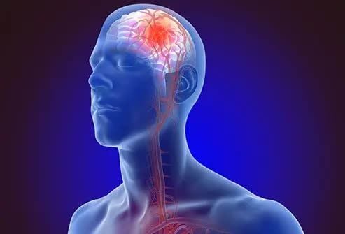 Ghaziabad, Health, Best Doctor For Stroke Treatment In Ghaziabad