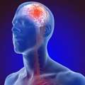 Best Doctor For Stroke Treatment In Ghaziabad