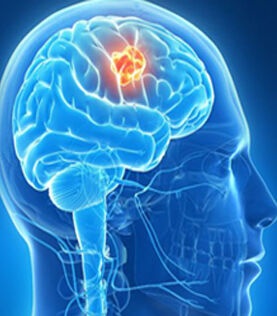 Bangalore, Medical, Brain Surgery In Bangalore