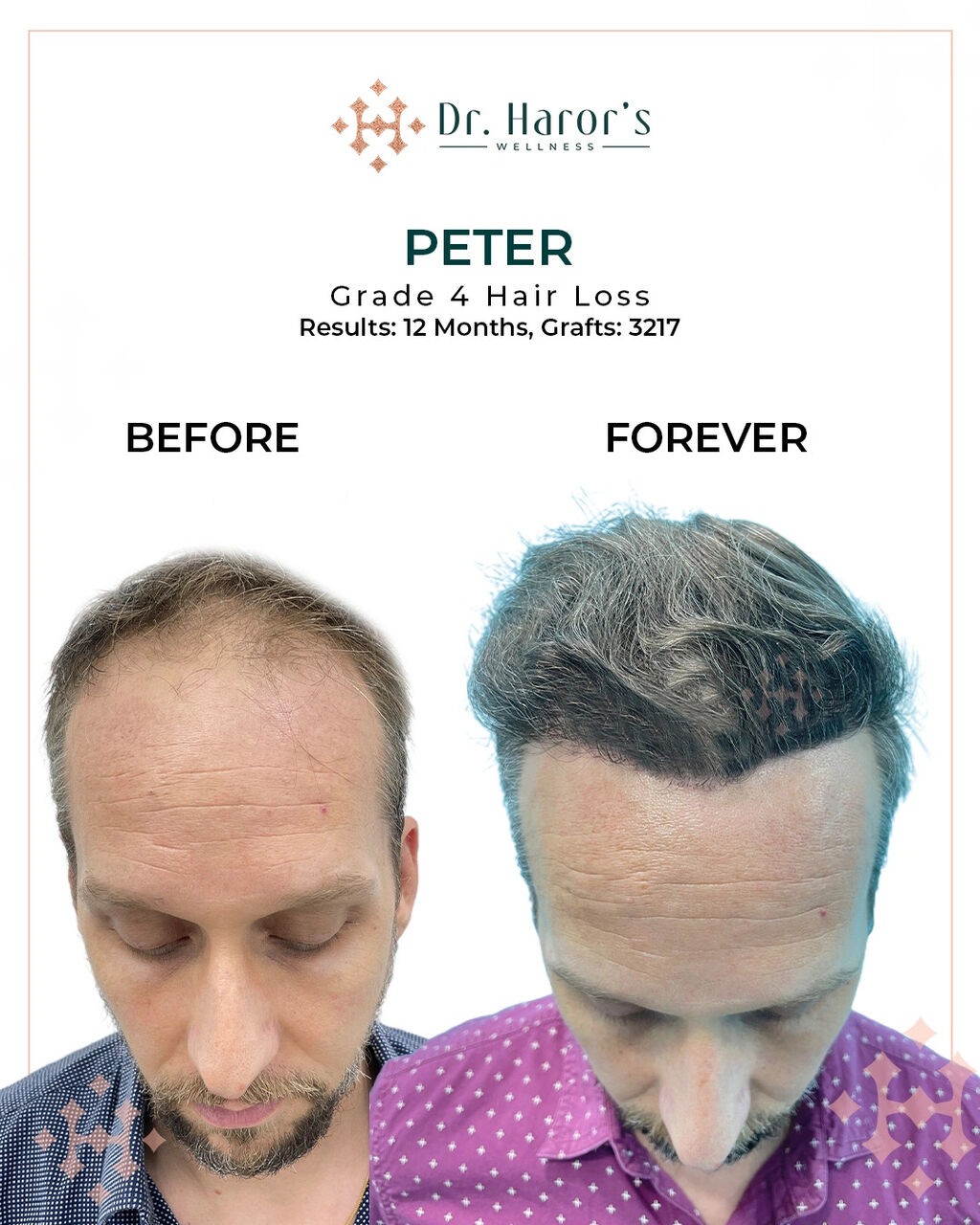 Berlin, Health, Experience The Best In Hair Restoration Excellence
