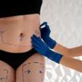 Liposuction Surgery In India At SB Aesthetics Clinic