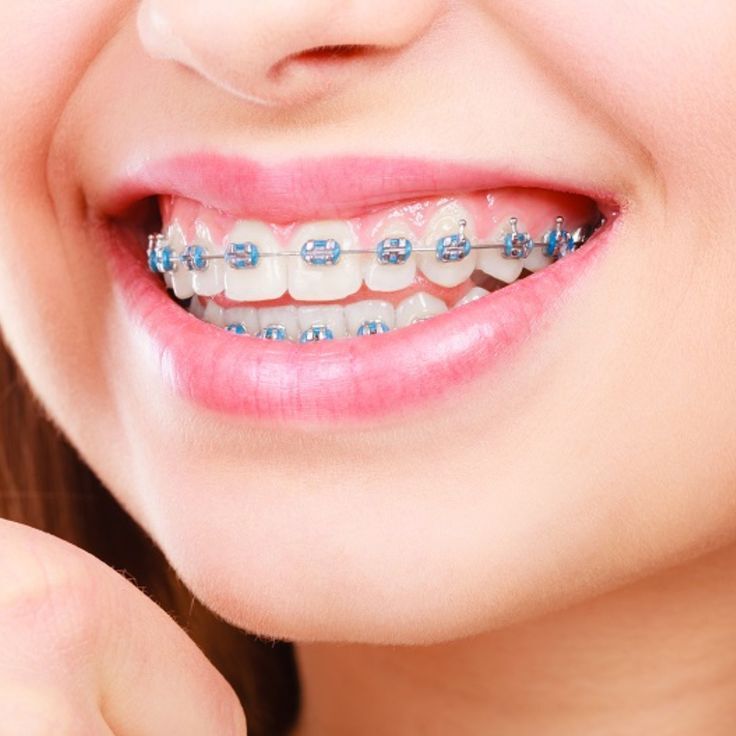 Pune, Dental, Braces Treatment In Pune | Affordable Dental Braces
