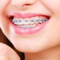 Braces Treatment In Pune | Affordable Dental Braces