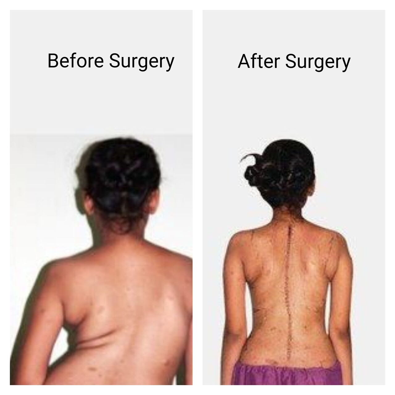 Visakhapatnam, Events, Kyphosis Correction Surgery In Vizag - Dr. B. Leela Prasad