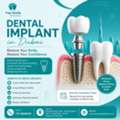 Dental Implants In Dubai | Top Smile Dental Clinic