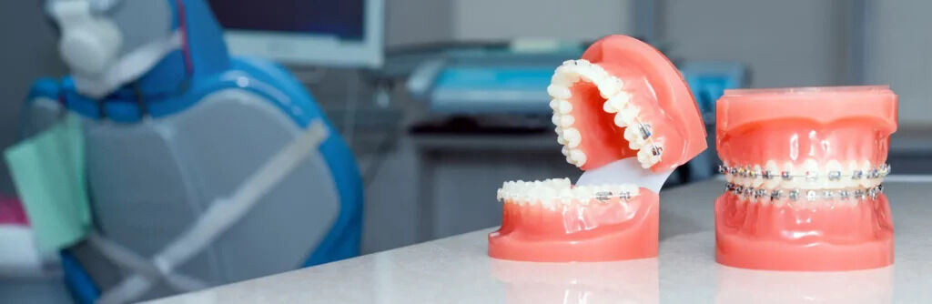 New York, Health, Braces In Artesia, CA - Art Family Dental