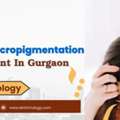 Best Clinic For Scalp Micropigmentation In Gurgaon - SB Trichology