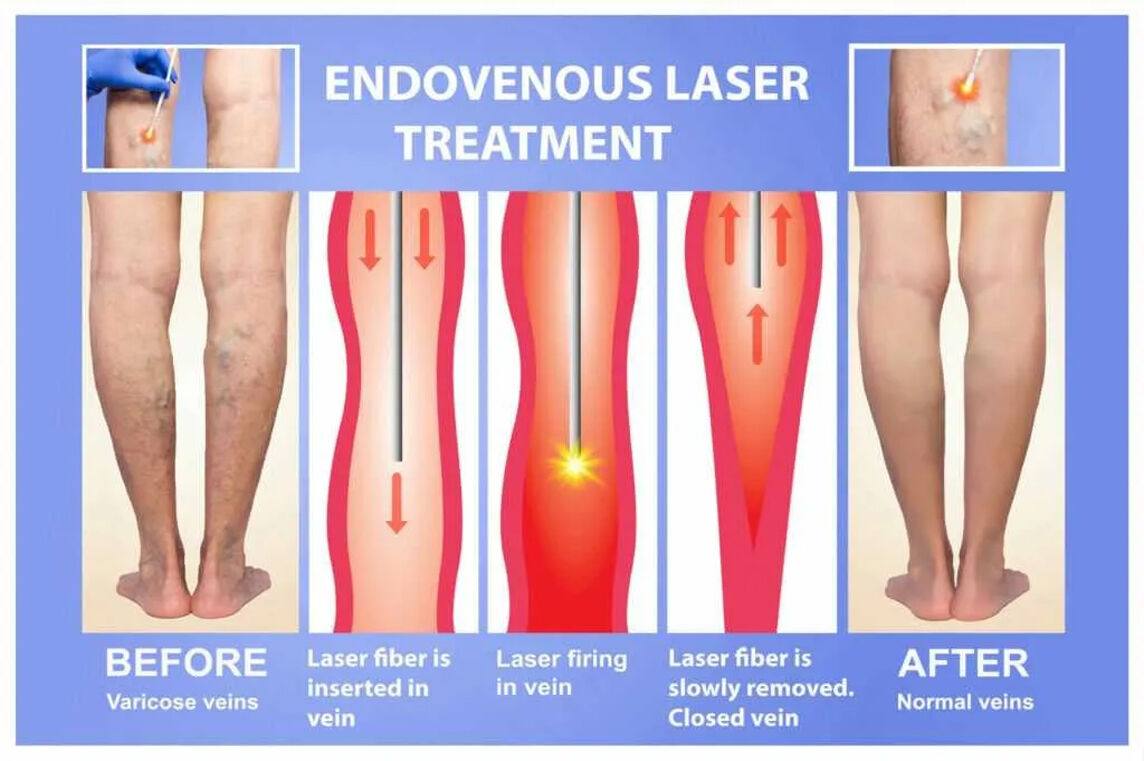 New York, Health, Northbrook Rosen Vein Care