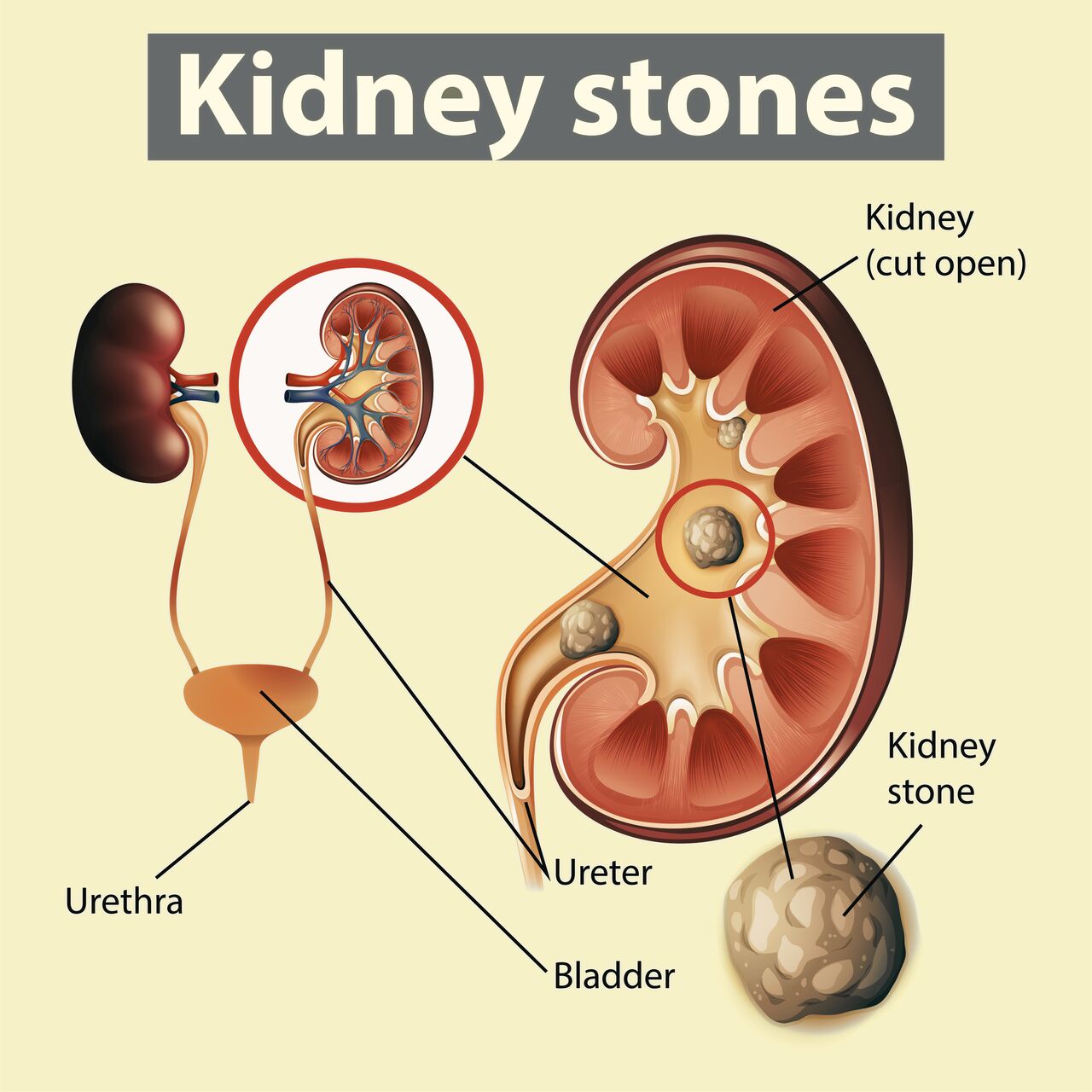 Lucknow, Health, Kidney Stone Surgery: URS, PCNL & Recovery Guide In Life Care Hospital