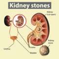Kidney Stone Surgery: URS, PCNL & Recovery Guide In Life Care Hospital