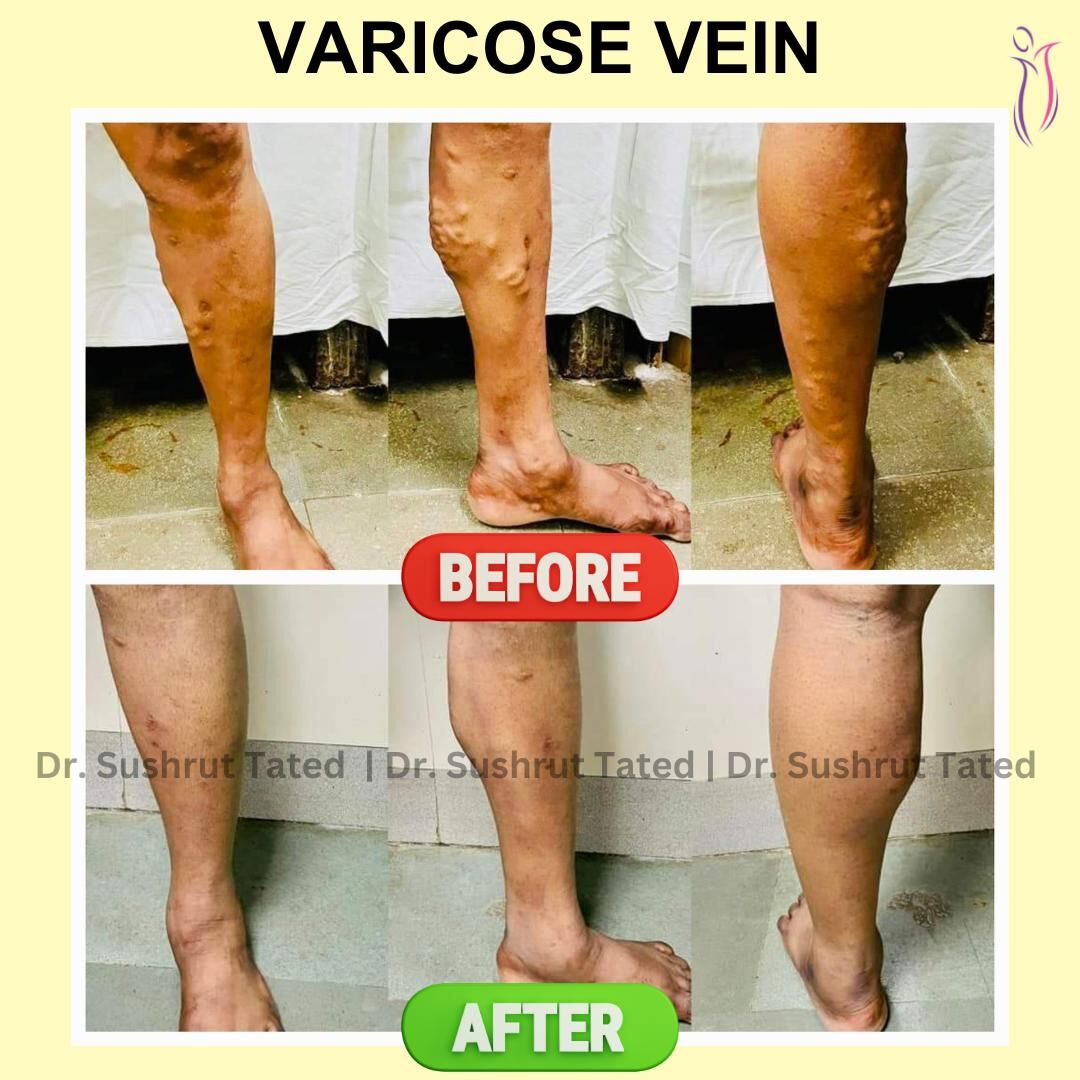 Pune, Medical, Varicose Veins Surgery In Baner - The Aesthetic Hub