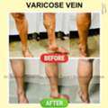 Varicose Veins Surgery In Baner - The Aesthetic Hub