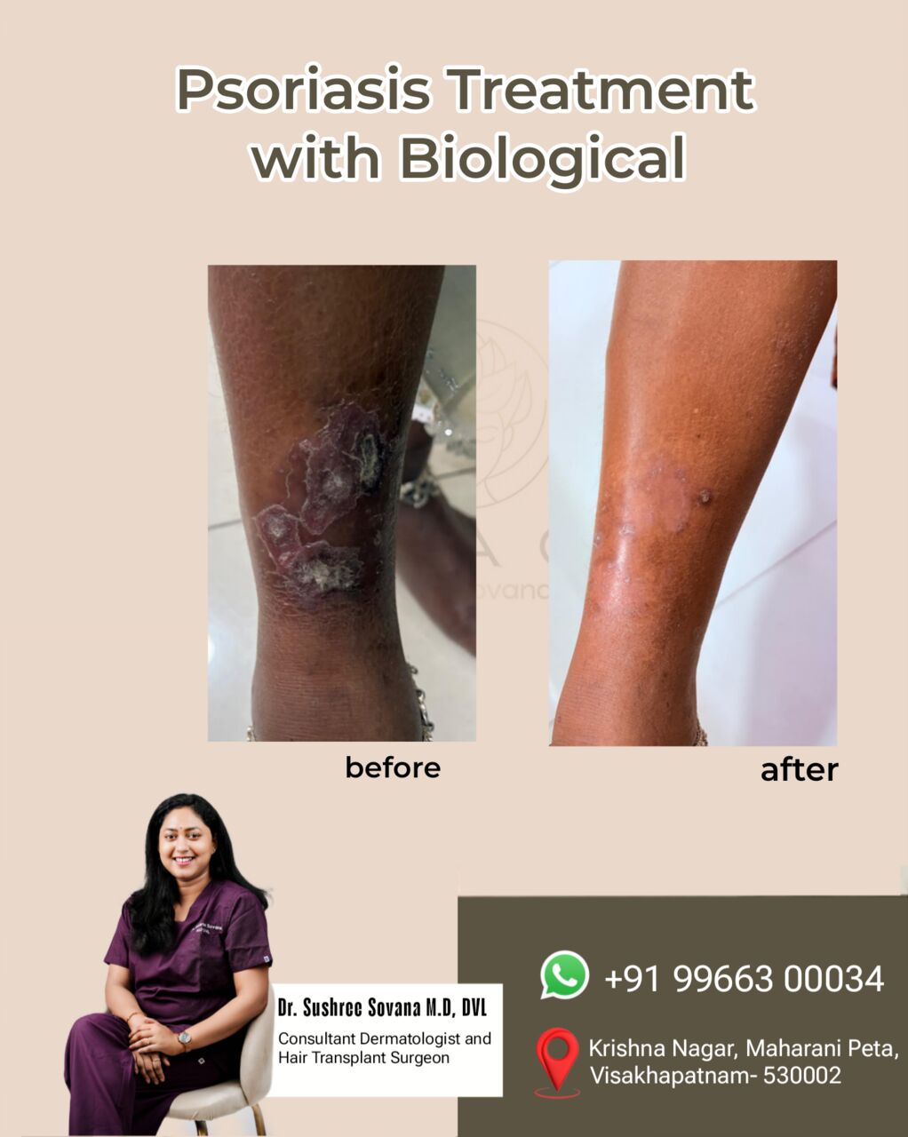 Visakhapatnam, Health, Psoriasis Treatment With Biologics &ndash; Real Results, Real Relief - Visakhpatnam