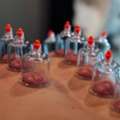 Best Cupping Therapy Services In Gurgaon | Pain Relief & Recovery