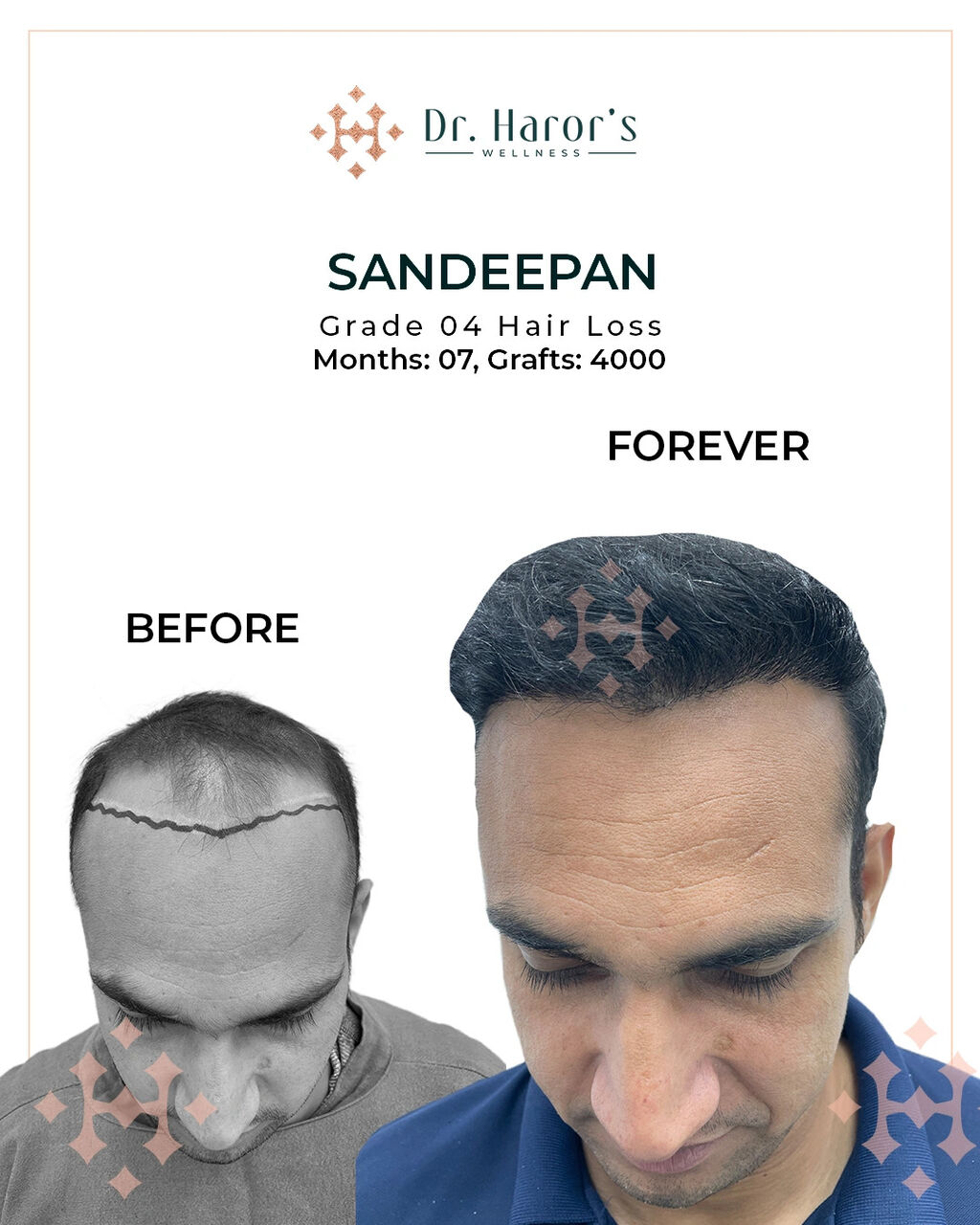 Berlin, Health, A Trusted Address For Hair Restoration In Germany