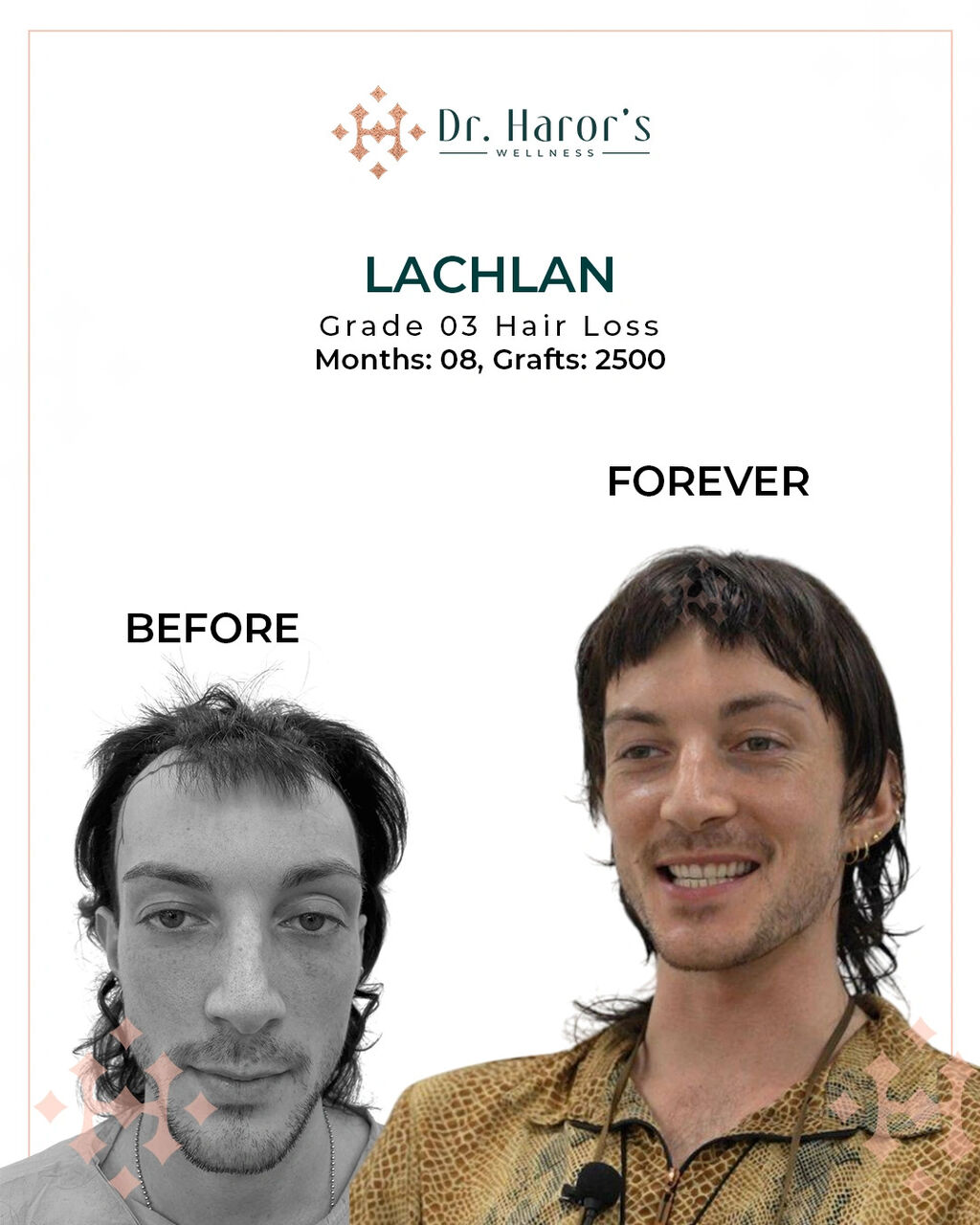 Berlin, Health, A Trusted Address For Hair Restoration In Germany