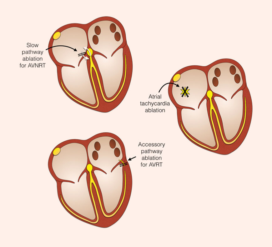Dubai, Health, Advanced SVT Ablation For Heart Rhythm Disorders | TheHeart.ae