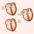 Advanced SVT Ablation For Heart Rhythm Disorders | TheHeart.ae