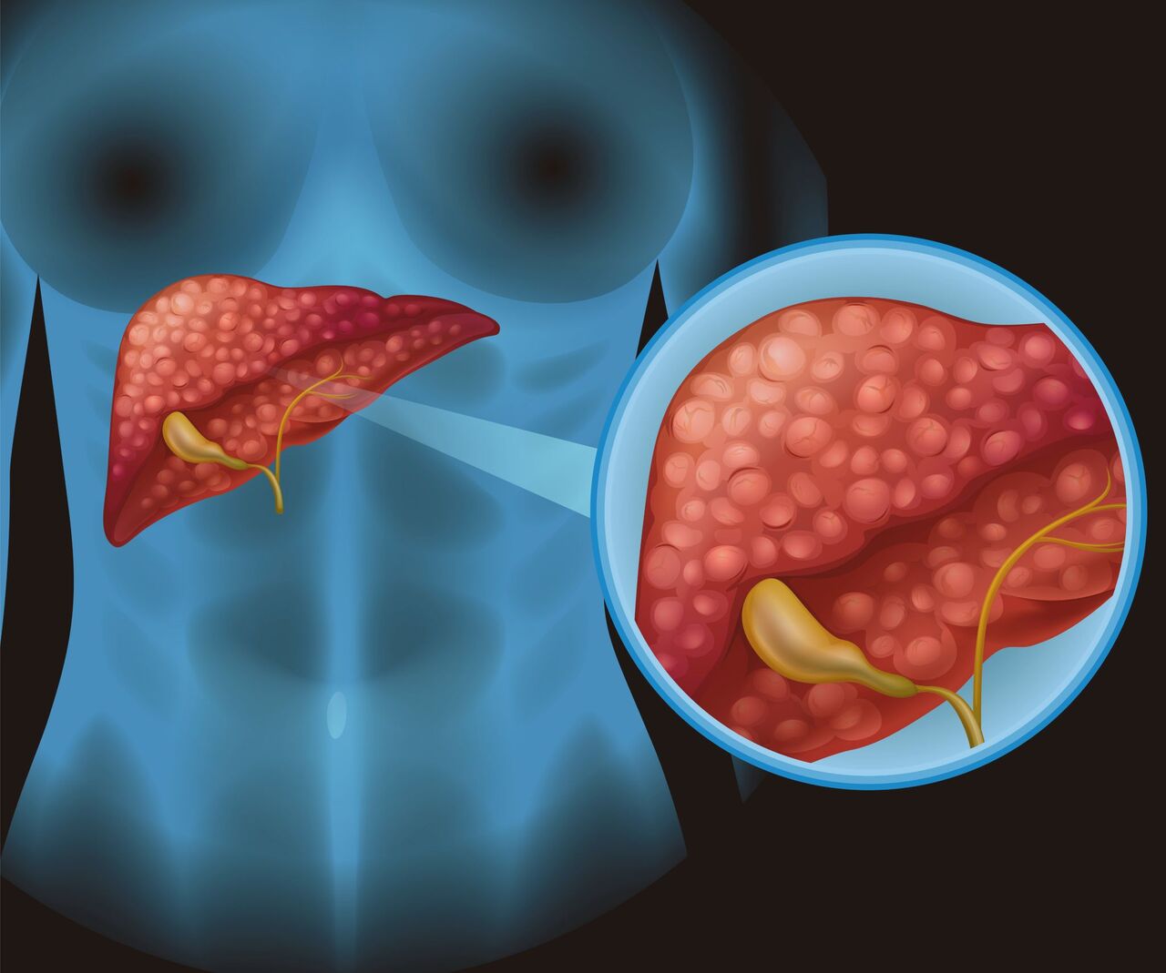 Lucknow, Health, Best Surgeon For Gallbladder Disease | Expert Gallbladder Surgery