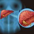 Best Surgeon For Gallbladder Disease | Expert Gallbladder Surgery