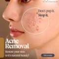 Pimples Treatment In Hyderabad