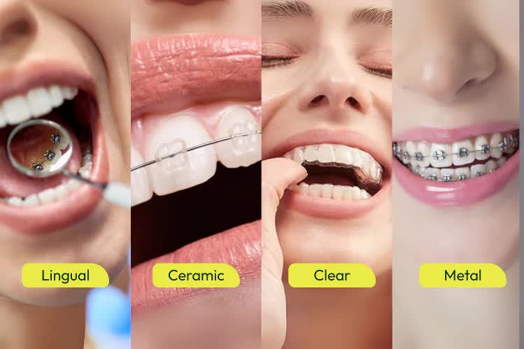 Mumbai, Health, Affordable Braces For Teeth Treatment Cost Guide