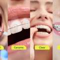 Affordable Braces For Teeth Treatment Cost Guide
