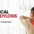 Cervical Spondylosis: Symptoms, Causes & Treatment