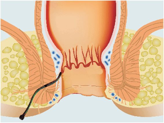 New Delhi, Health, Fistula Treatment In Delhi NCR