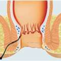 Fistula Treatment In Delhi NCR